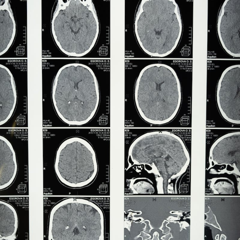 Posibles resultados de una resonancia magnética RM.